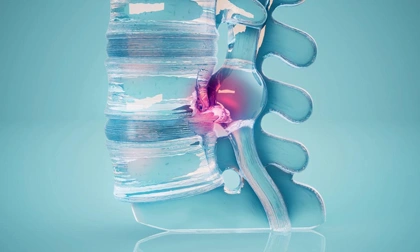 Minimally Invasive Spine Surgery