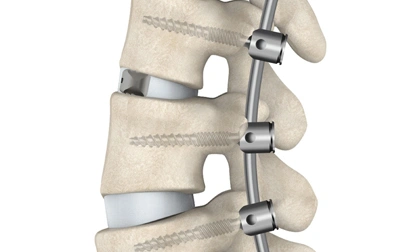 Spinal Fusion Surgery